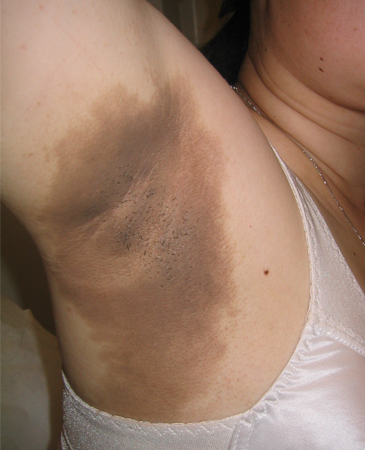 Type 2 diabetes in adults images