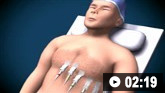 Como realizar uma demonstração animada do ECG